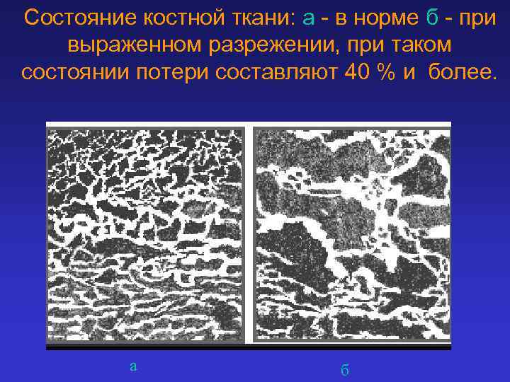 Состояние костной ткани: а - в норме б - при выраженном разрежении, при таком