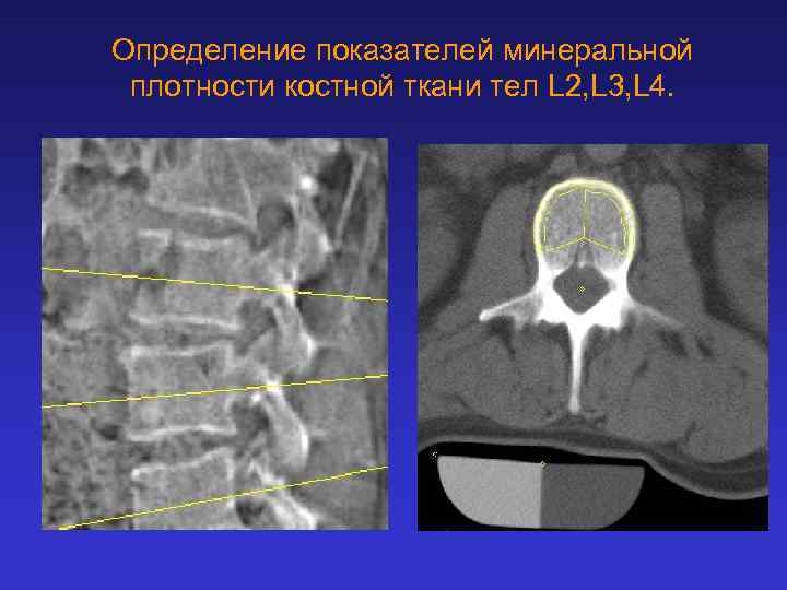Определение показателей минеральной плотности костной ткани тел L 2, L 3, L 4. 