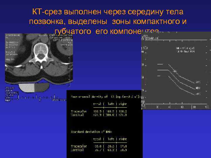 КТ-срез выполнен через середину тела позвонка, выделены зоны компактного и губчатого его компонентов. 