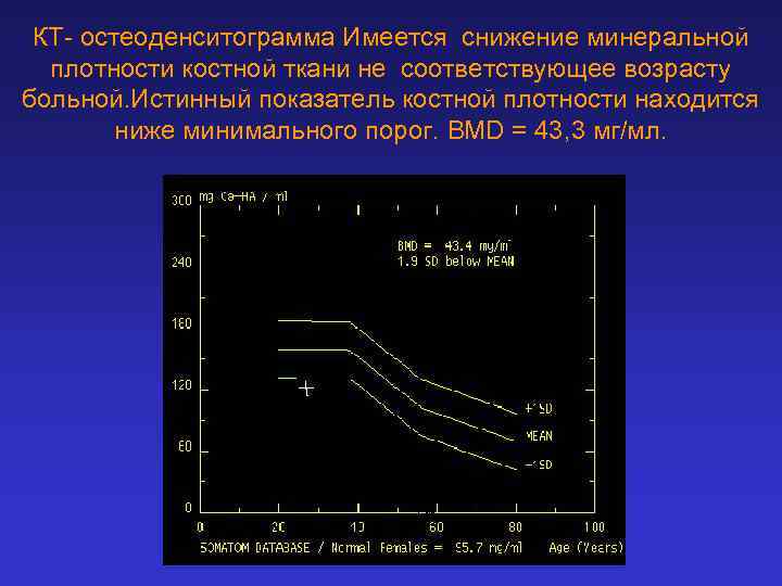 КТ- остеоденситограмма Имеется снижение минеральной плотности костной ткани не соответствующее возрасту больной. Истинный показатель