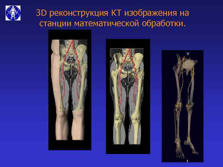 3 D реконструкция КТ изображения на станции математической обработки. 