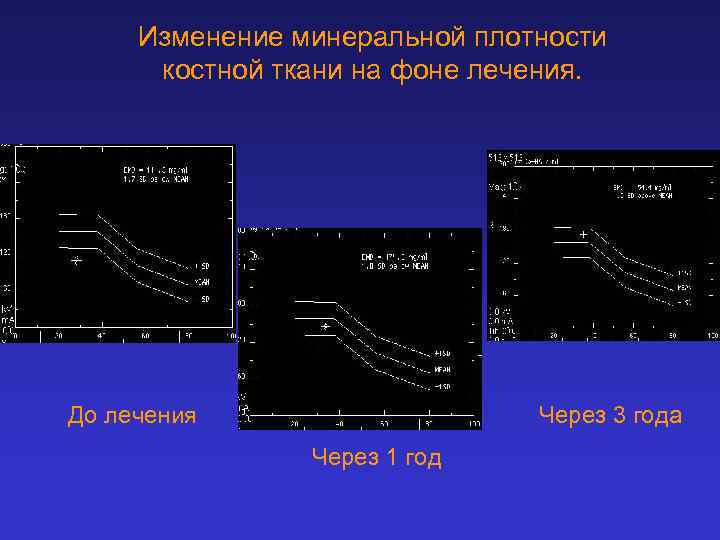 Изменение минеральной плотности костной ткани на фоне лечения. До лечения Через 3 года Через