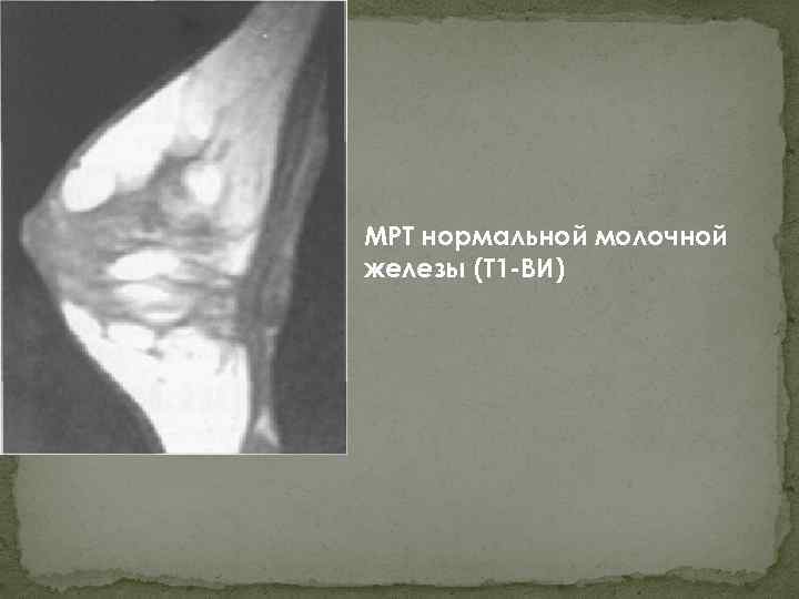 МРТ нормальной молочной железы (Т 1 -ВИ) 