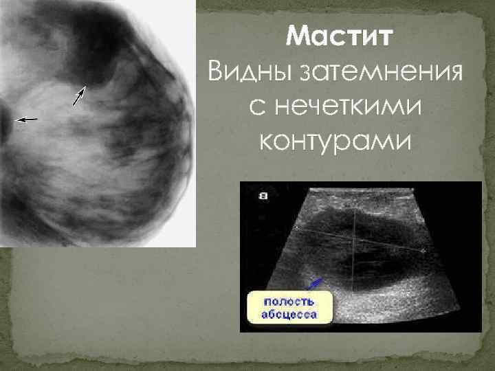 Мастит Видны затемнения с нечеткими контурами 