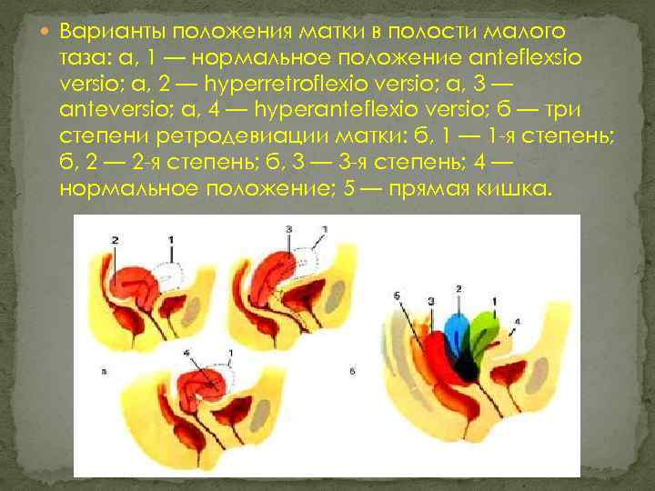  Варианты положения матки в полости малого таза: а, 1 — нормальное положение anteflexsio