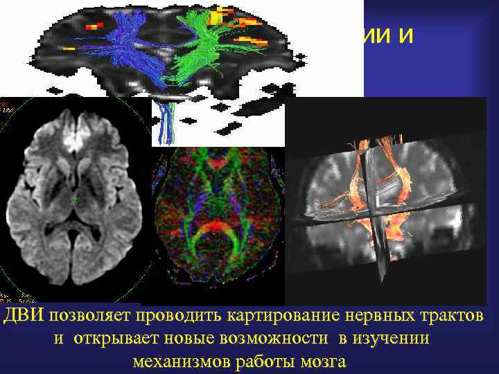 Анизотропия диффузии и трактография ESNR 2005 ДВИ позволяет проводить картирование нервных трактов и открывает