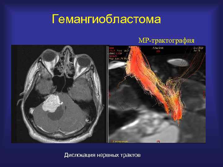 Гемангиобластома МР-трактография Дислокация нервных трактов 
