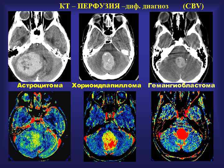 КТ – ПЕРФУЗИЯ –диф. диагноз Астроцитома Хориоидпапиллома (CBV) Гемангиобластома 