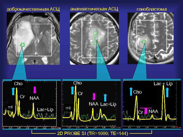 доброкачественная АСЦ анапластическая АСЦ Cho Cr m. I глиобластома Cho Cr NAA Lac+Lip Lac
