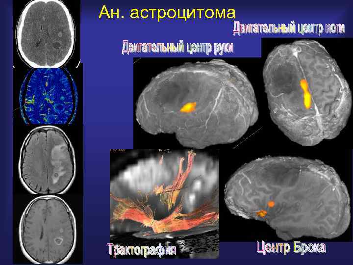 Ан. астроцитома 