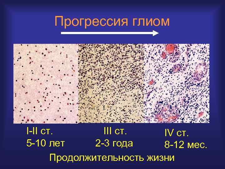 Прогрессия глиом I-II ст. IV ст. 5 -10 лет 2 -3 года 8 -12