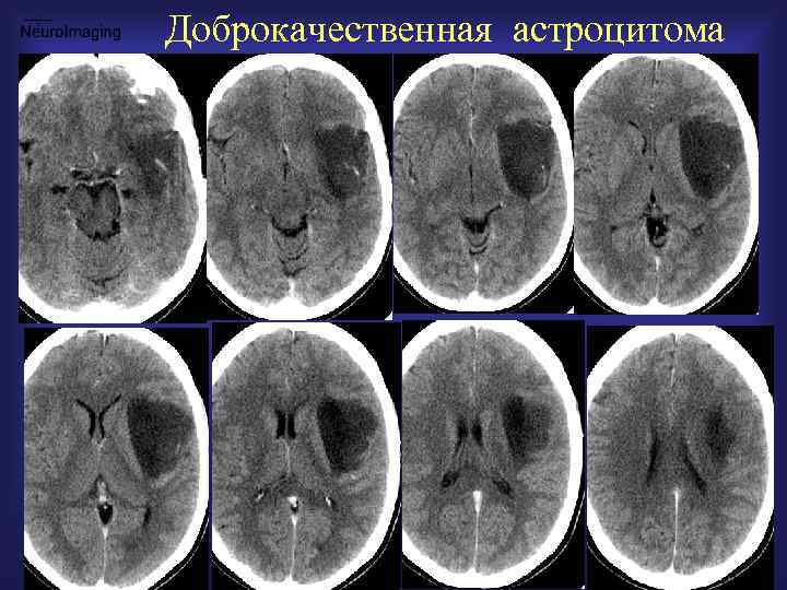 Доброкачественная астроцитома 