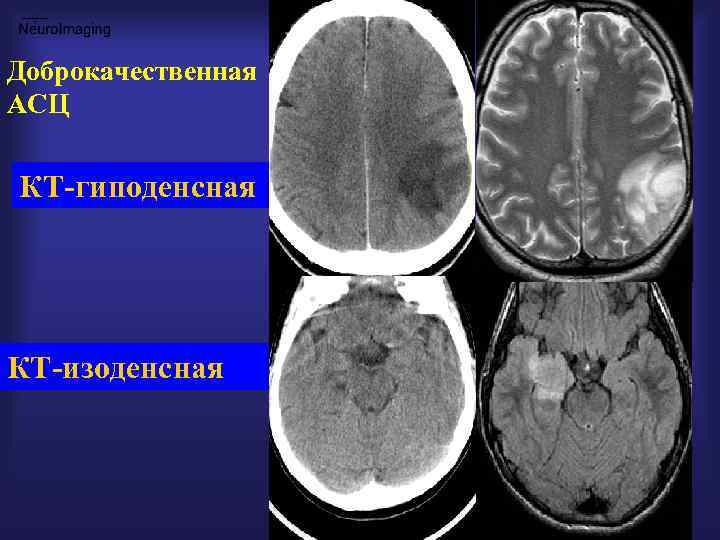 Гиперденсные структуры на кт изображениях