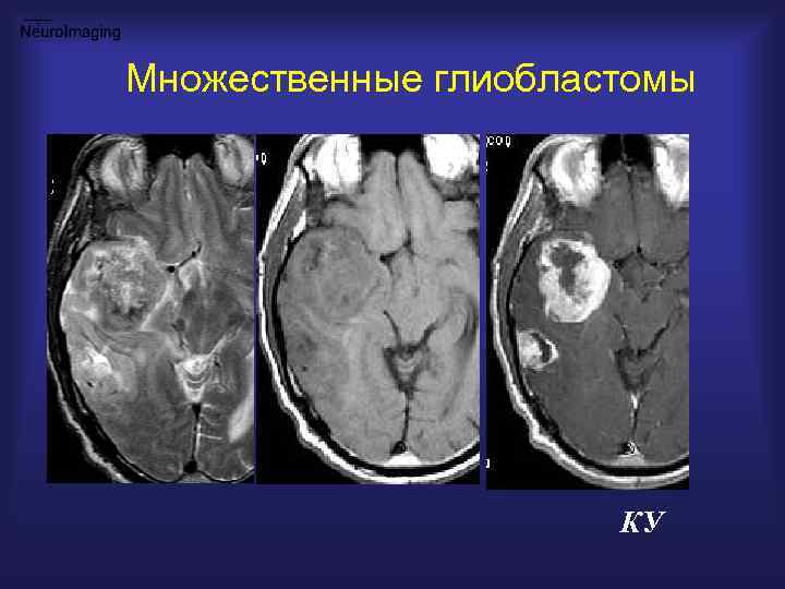 Множественные глиобластомы КУ 