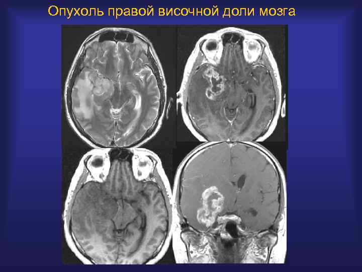 Опухоль правого. Опухоль правой височной доли. Опухоль мозга височной доли. Опухоль правой височной доли головного мозга.