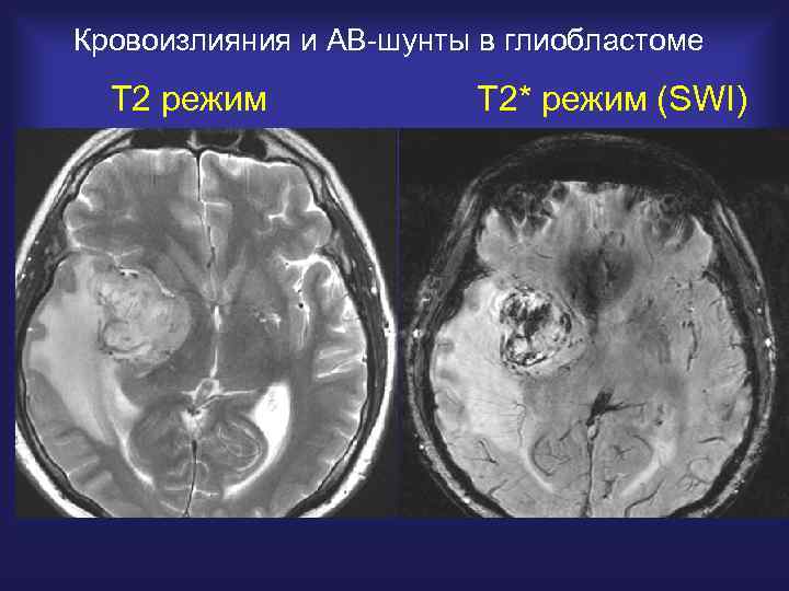 Кровоизлияния и АВ-шунты в глиобластоме Т 2 режим Т 2* режим (SWI) 
