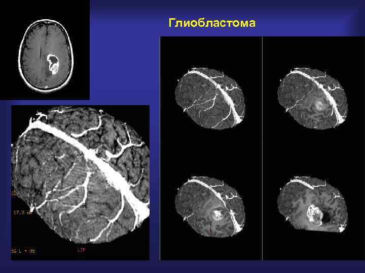 Глиобластома 