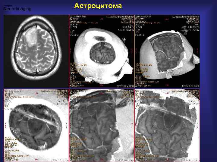 Астроцитома 