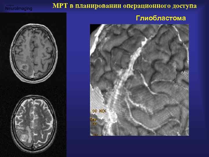 МРТ в планировании операционного доступа Глиобластома 