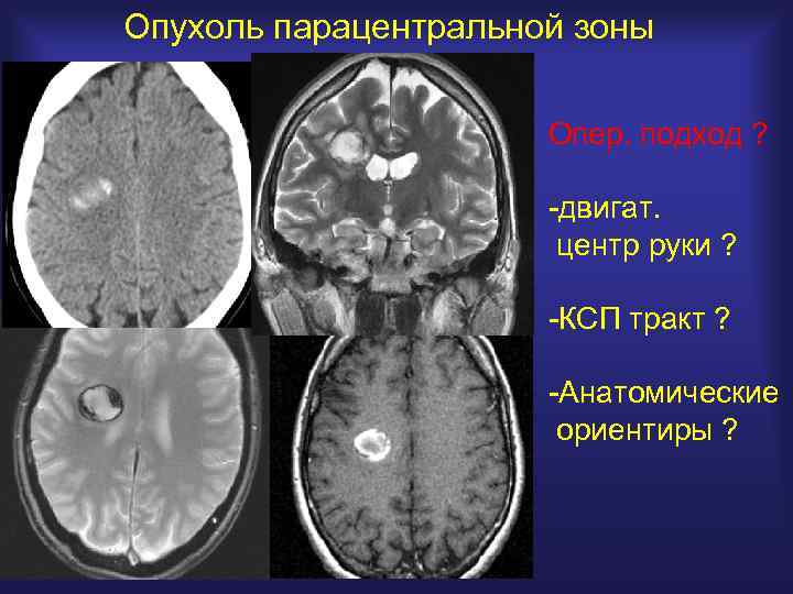 Опухоль парацентральной зоны Опер. подход ? -двигат. центр руки ? -КСП тракт ? -Анатомические