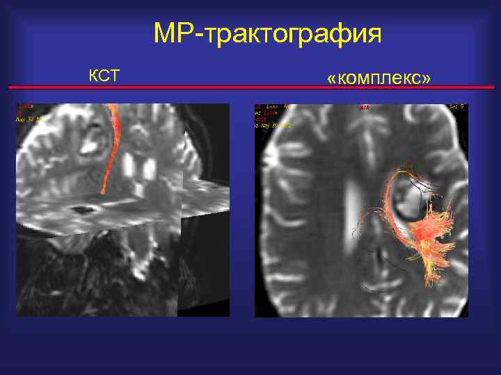 МР-трактография КСТ «комплекс» 