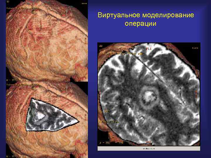 Виртуальное моделирование операции 