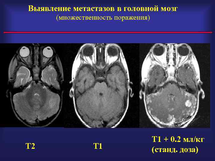 Выявление метастазов в головной мозг (множественность поражения) Т 2 Т 1 + 0. 2
