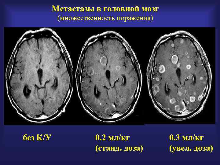 Метастазы в мозг прогноз