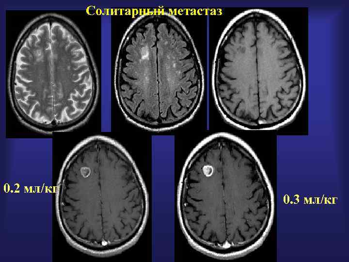 Солитарный метастаз 0. 2 мл/кг 0. 3 мл/кг 