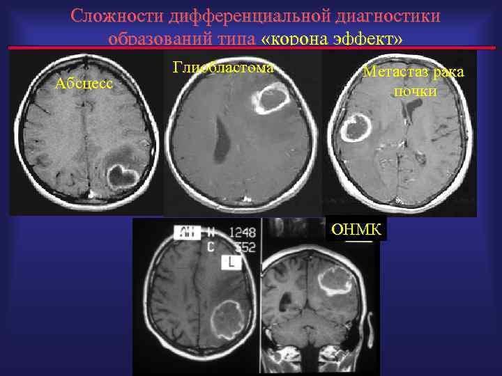 Сложности дифференциальной диагностики образований типа «корона эффект» Абсцесс Глиобластома РС Метастаз рака почки ОНМК