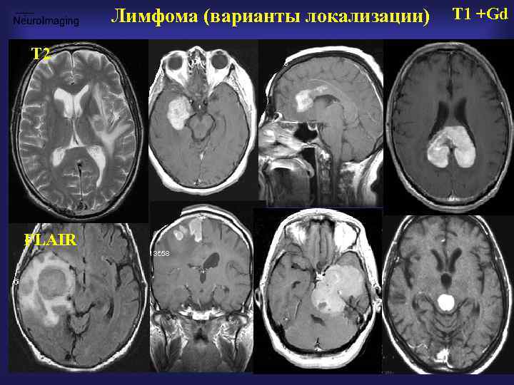 Лимфома (варианты локализации) Т 2 FLAIR T 1 +Gd 
