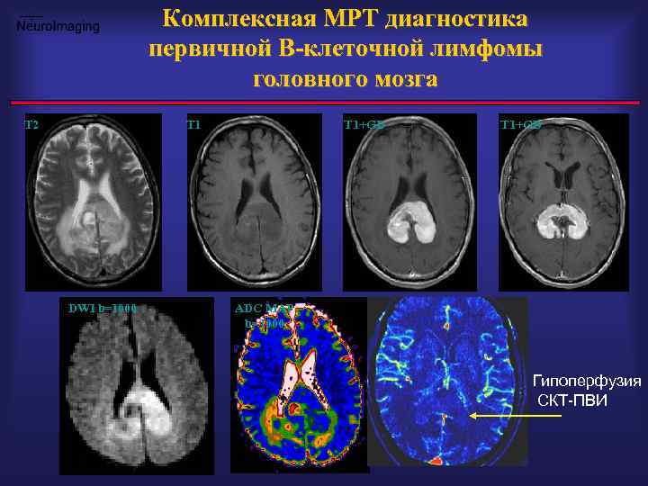 Комплексная МРТ диагностика первичной B-клеточной лимфомы головного мозга T 2 T 1 DWI b=1000