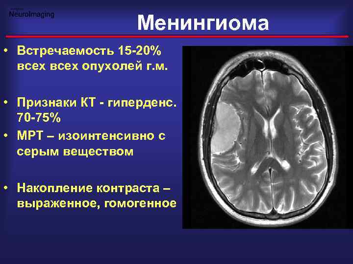 Менингиома на кт