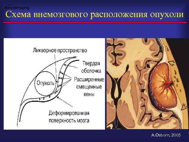 Схема внемозгового расположения опухоли A. Osborn, 2005 