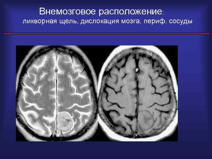 Межполушарная щель