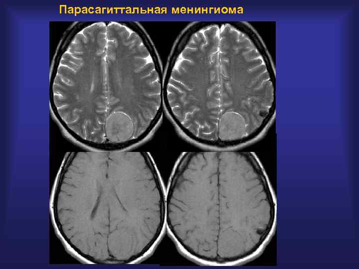 Менингиома головного. Фалькс-менингиома лобной области на мрт. Кальцинированная менингиома на кт. Конвекситальные менингиомы лобной.