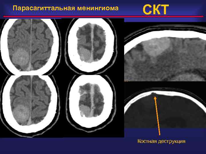 Парасагиттальная менингиома СКТ Костная деструкция 