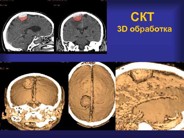 СКТ 3 D обработка 