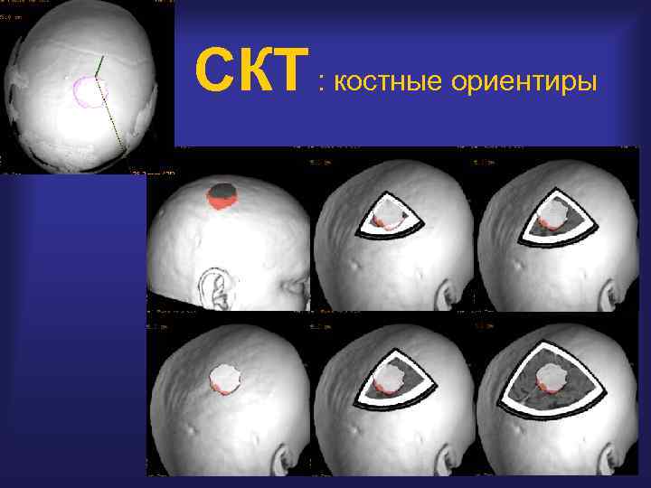 СКТ : костные ориентиры 