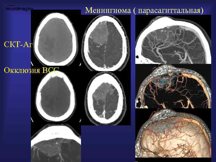 Менингиома головного мозга. Парасагиттальная менингиома. Парасагиттальная менингиома кт. Локализация менингиом. Парасагиттальная опухоль.