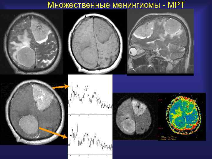 Множественные менингиомы - МРТ 