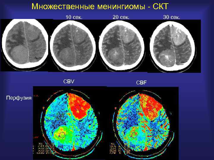 Менингиома головного мозга форум. Перфузия опухоли головного мозга кт. Менингиома лобной области мрт. СКТ головного мозга. Кт перфузия.