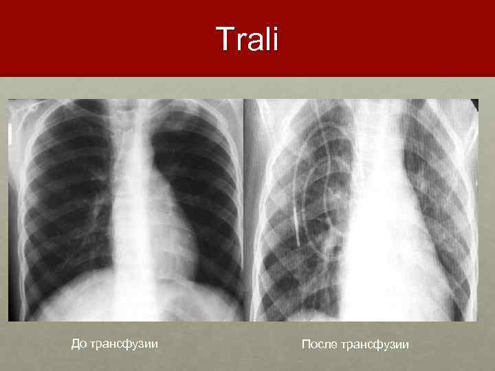 Trali До трансфузии После трансфузии 