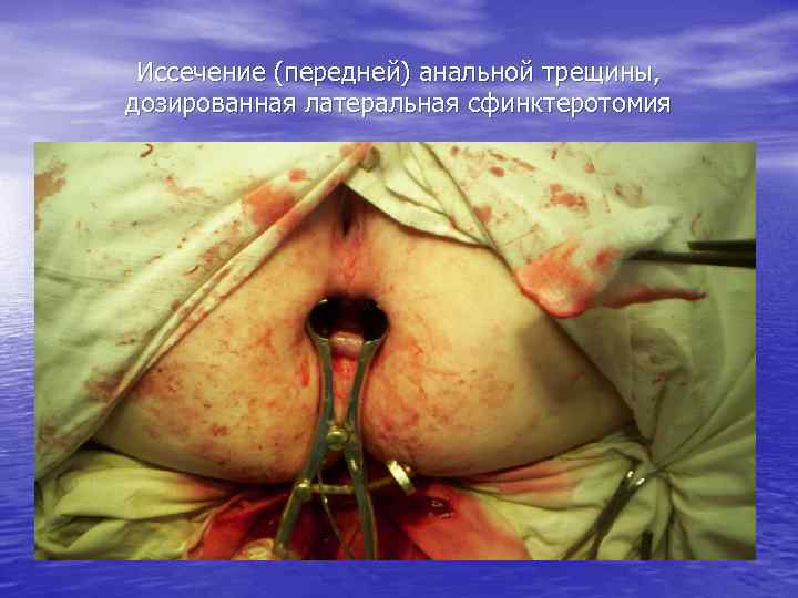 Иссечение (передней) анальной трещины, дозированная латеральная сфинктеротомия 