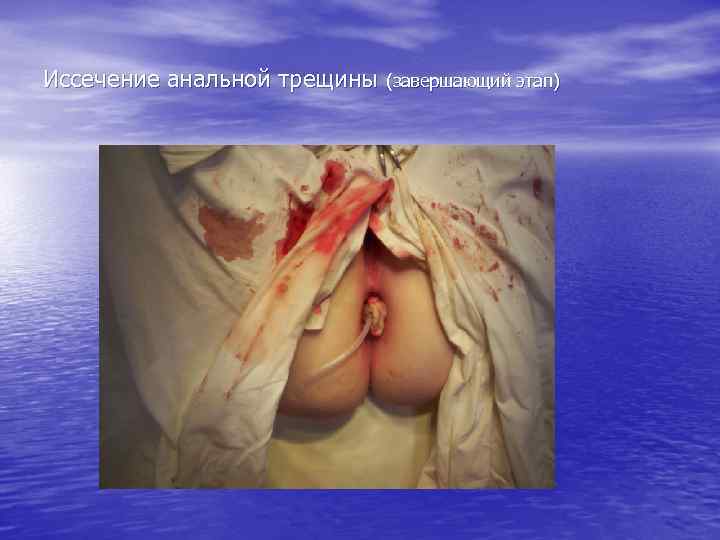 Иссечение анальной трещины (завершающий этап) 