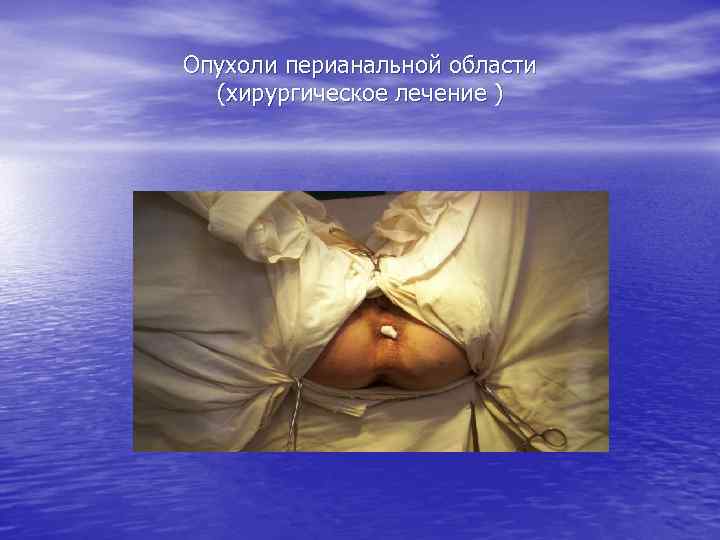 Опухоли перианальной области (хирургическое лечение ) 