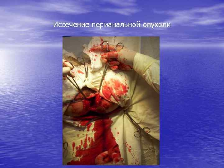 Иссечение перианальной опухоли 