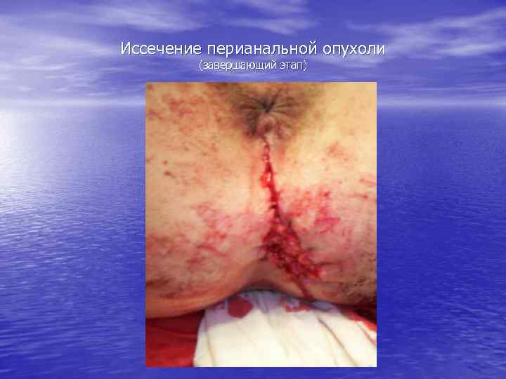 Иссечение перианальной опухоли (завершающий этап) 