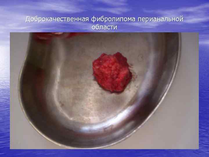 Доброкачественная фибролипома перианальной области 