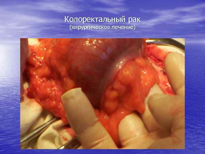 Колоректальный рак (хирургическое лечение) 